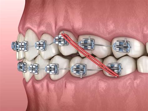 corrective braces for teeth